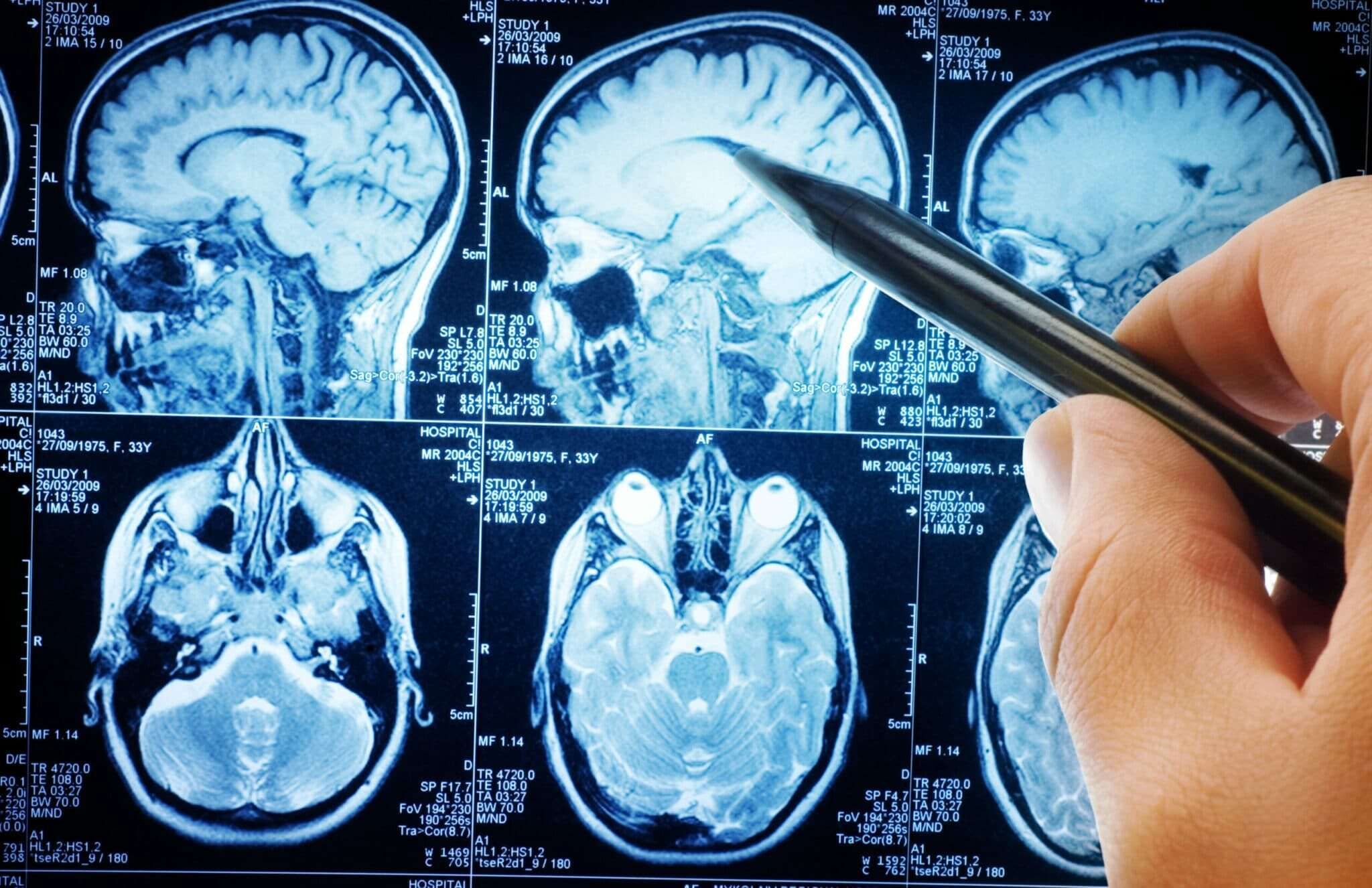 Le CBD semble augmenter la connectivité entre certaines régions du cerveau